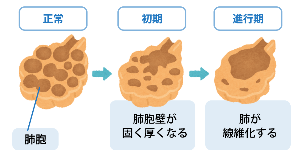 「肺胞」の図 正常→初期 肺胞壁が固く厚くなる→進行期 肺が線維化する